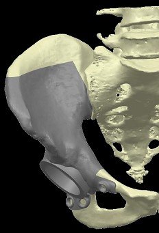 sarcoma osseo, primo intervento cto torino, render 3d