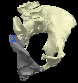 sarcoma osseo, primo intervento cto torino, render 3d