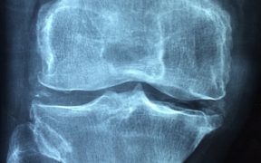 radiografia del ginocchio usurato