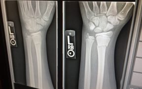 radiologia, radiografia mano