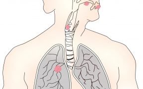 cancro alle vie respiratorie
