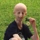 Sammy Basso progeria